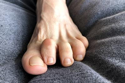 Toes with hammertoe deformity in close detail