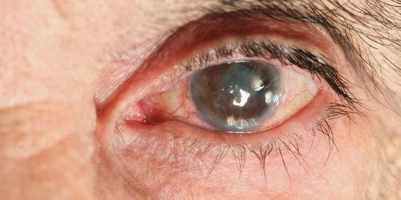 Eye Diseases In The Elderly