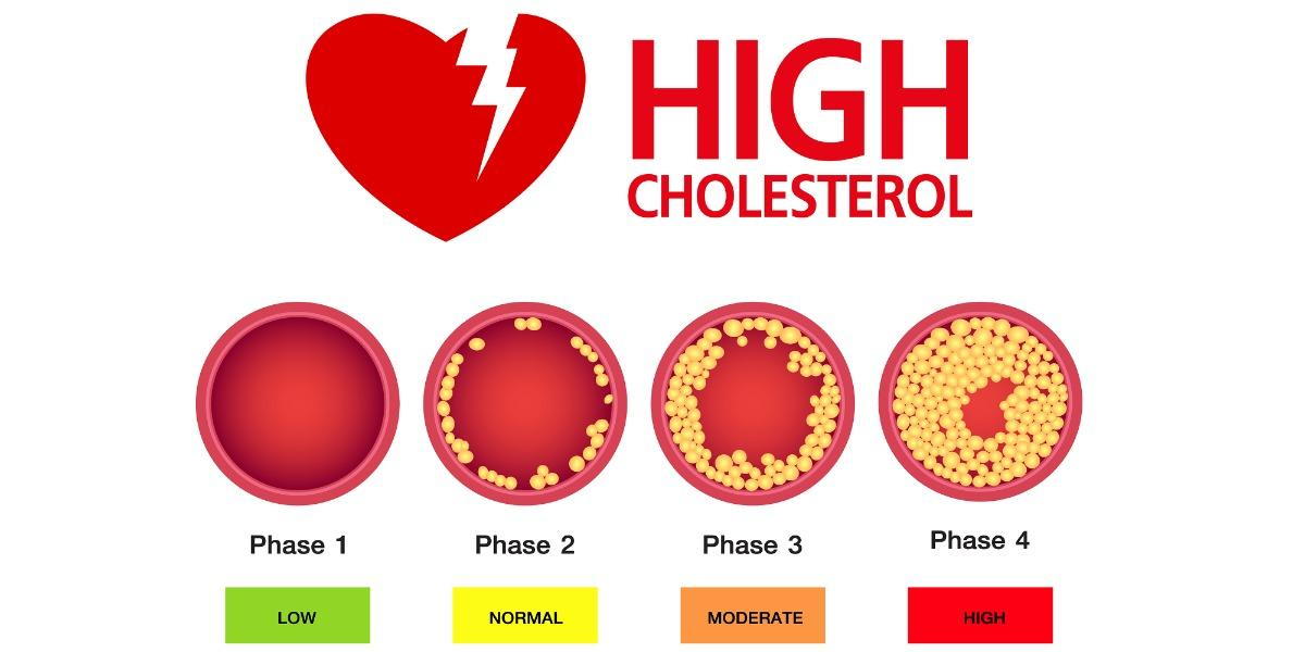 Illustration depicting phases of plaque formation due to high cholesterol