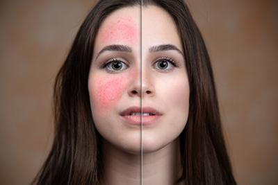 Comparison-of-a-Woman’s-Skin-Before-and-After-Rosacea-Laser-Treatment