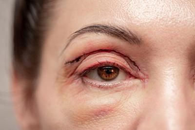 Close-up of woman’s eyes after eyelid lift surgery