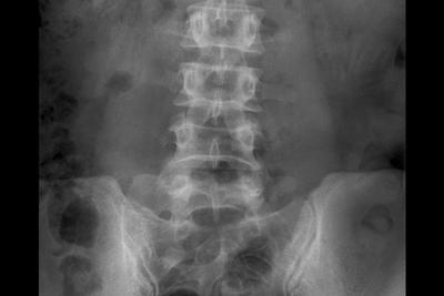 Illustration of Bertolotti Syndrome on x-ray