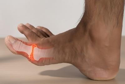 Skeletal-view-of-Gout-in-foot-of-a-person-in-red.