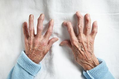 Visible signs of rheumatoid arthritis in an older woman’s hands
