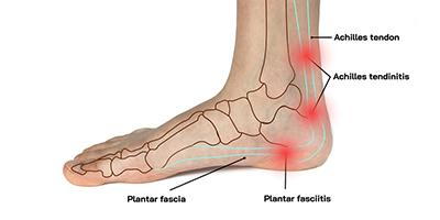 Image-Showing-Plantar-Fasciitis-and-Achilles-Tendinitis-Areas-of-Pain