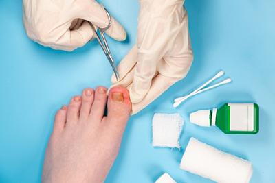 Ingrown toenail being treated by the podiatrist with cleaning tools.