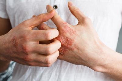 Man-with-Eczema