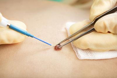 Procedure of mole removal on skin of patient