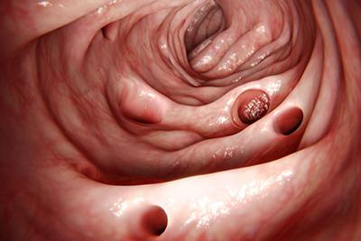 Colon-with-Diverticula