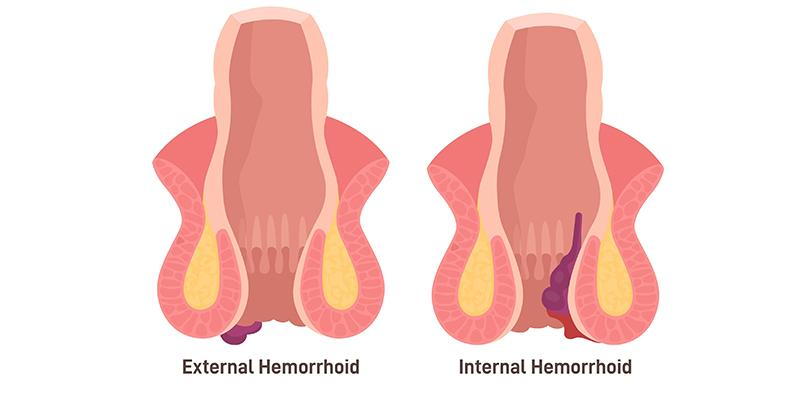 internal-and-External-Hemorrhoids