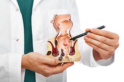 Illustration-of-anal-abscess-condition