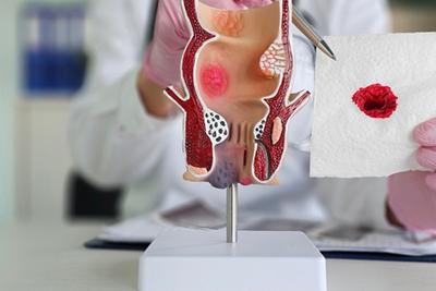 Medical professional showing rectum model alongside blood-stained tissue
