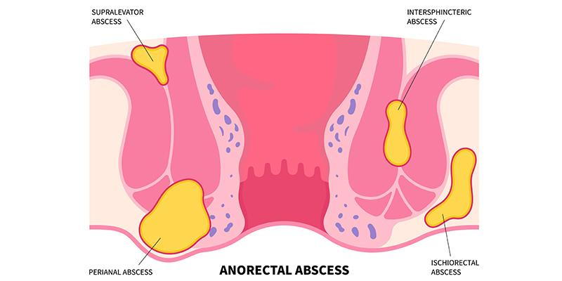 Diagram depicting an anorectal abscess and its location in the anal area.