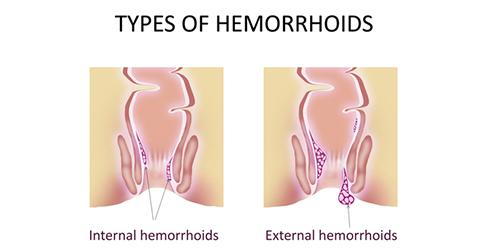 Diagram showing the difference between internal and external hemorrhoids