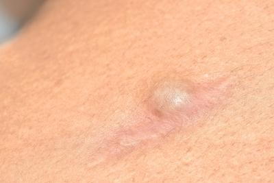 Pilonidal on skin of patient