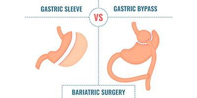 Gastric-Bypass-vs-Gastric-Sleeve-Concept