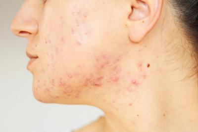 Severe-cystic-acne-on-jawline-and-lower-cheek