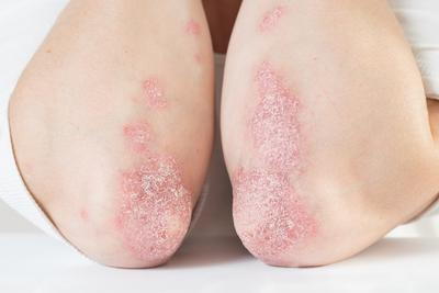 Caucasian-skin-arm-suffered-in-Eczema-with-redness.