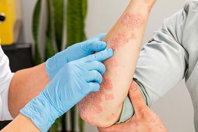 Person with eczema on arms check by the doctor