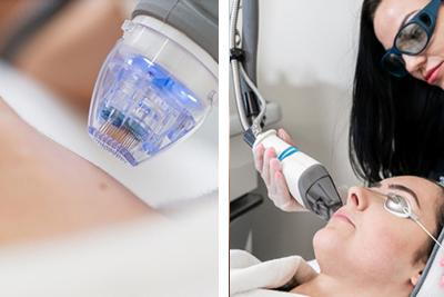 Visual comparison highlighting the differences between microneedling and laser therapy for skin improvement.
