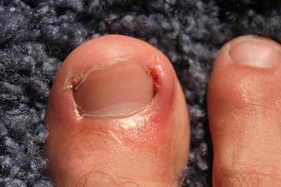 Man-with-Ingrown-Toenail