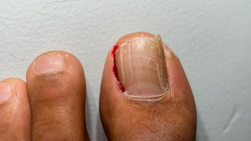 Person suffering from Ingrown Toenails with blood and swelling.