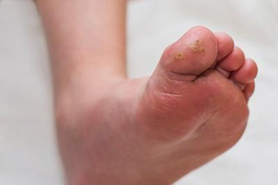 Childs-Toe-With-Plantar-Warts