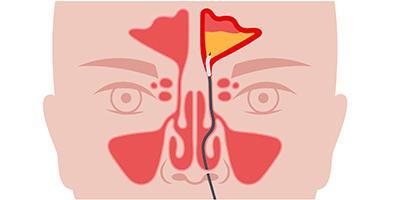 Medical illustration depicting balloon sinuplasty procedure to open blocked sinuses