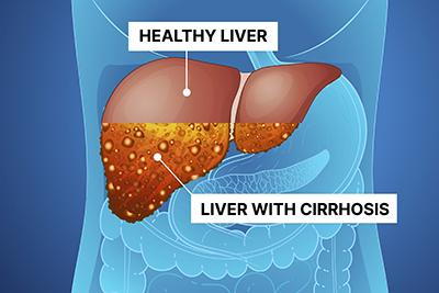 Liver-Cirrhosis-Concept