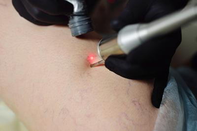 Laser-Treatment-for-Vascular-and-Pigmented-Lesions
