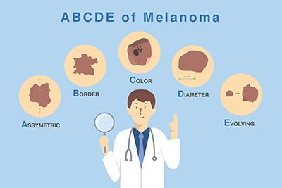 illustration-of-How-to-Distinguish-Cancerous-Moles
