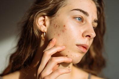 Woman-with-Acne