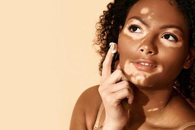 Woman-Applying-Topical-Treatment-for-Vitiligo