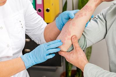 Dermatologist evaluating scaly, inflamed elbow skin caused by psoriasis