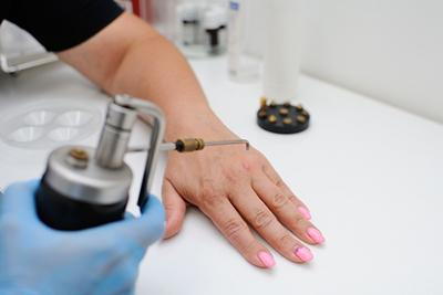 Dermatologist performing cryotherapy to freeze and treat skin warts