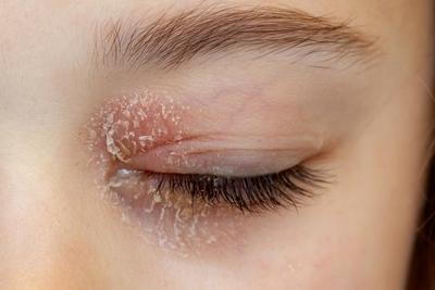 Womans eye with Atopic Dermatitis infection
