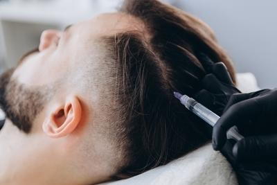 Man injected in scalp for hair restoration process on clinic.