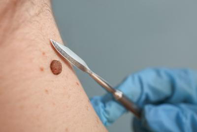 Small knife in removing mole in the skin.