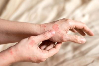 Person suffering in Psoriasis on hand.