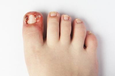 Close-up of inflamed toe with ingrown nail