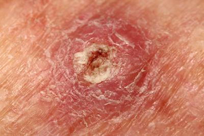 Clinical close-up of squamous cell carcinoma on patient’s skin