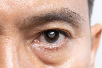 Man looking with cataracts in his eye or white lid.