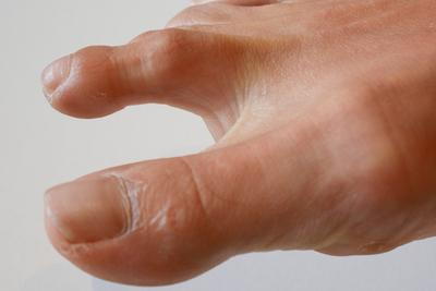 Illustration of hammertoe condition