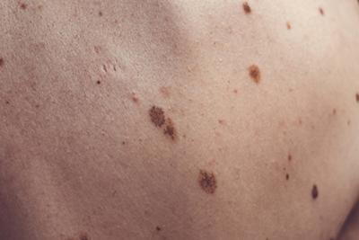 Melanoma in the back skin of the patient