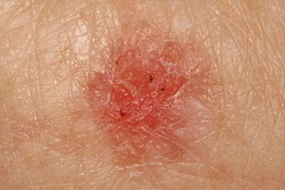 Detailed view of squamous cell carcinoma on skin