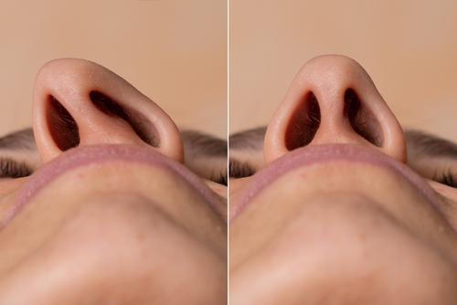 Side-by-side comparison showing a deviated septum before and after septoplasty surgery.