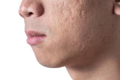 Man-With-Acne-Scars