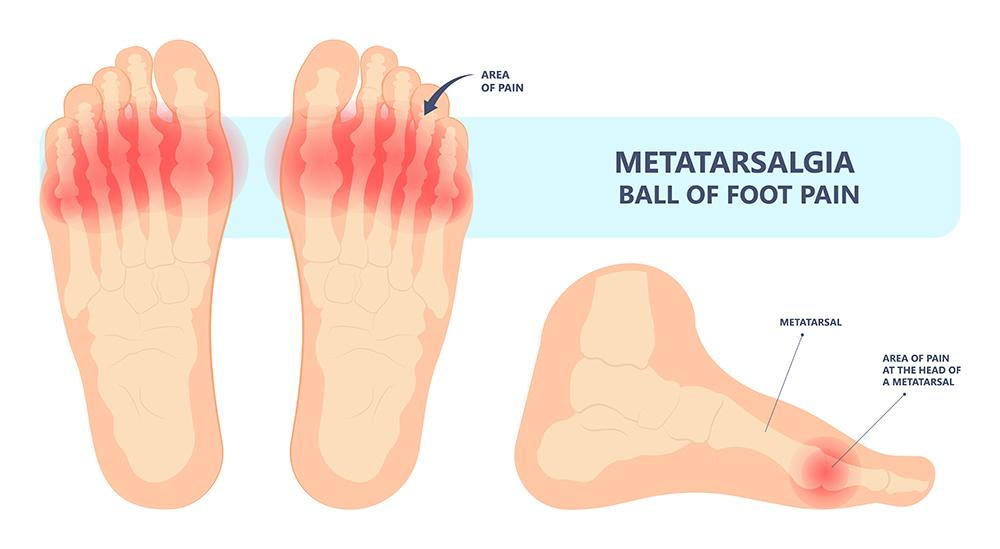 Diagram of ball of foot pain (metatarsalgia) in human foot.