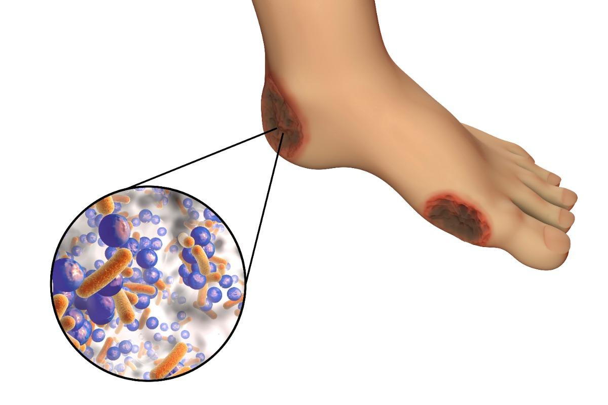 How to Avoid Athlete's Foot and Staph Infections: Cortez Foot & Ankle  Specialists: Podiatry