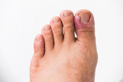 Detailed image of a toenail infection caused by an ingrown nail with visible discharge.